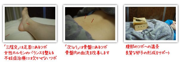 不妊症の鍼灸治療の実際