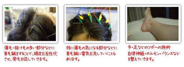 育毛鍼の鍼灸治療の実際